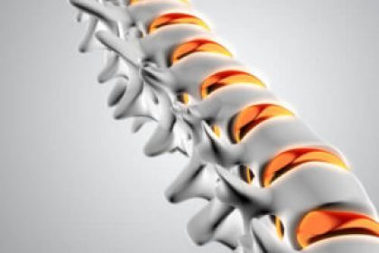 Osteoporosis-Health-Screen-300×300