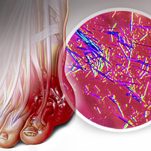 Tampa Uric Acid Test 24/7 Labs