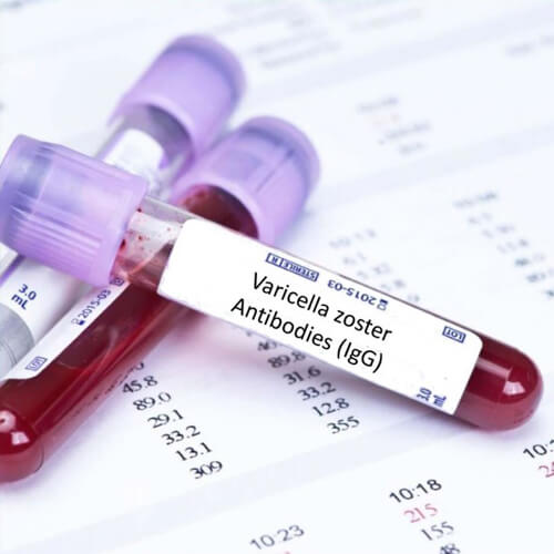 Tampa Varicella Zoster V A/B IgG Test 24/7 Labs