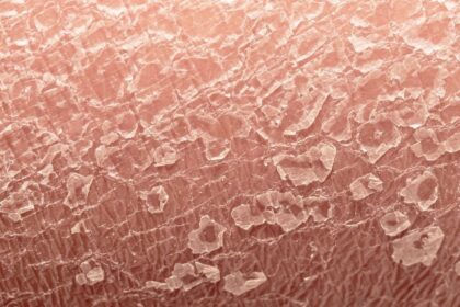 Psoriasis Psoriasis